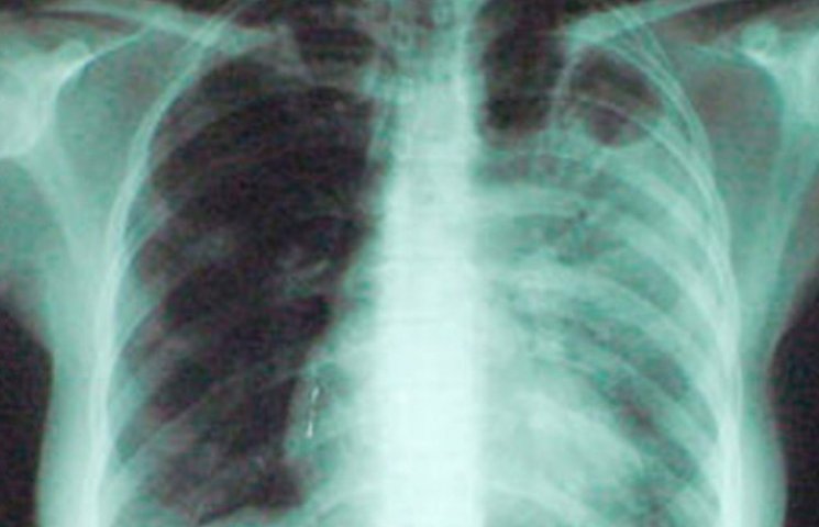 На Закарпатті більшає хворих на туберкул…