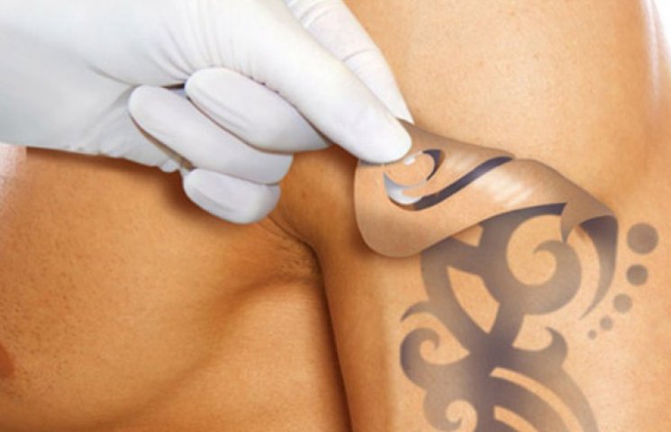 Выведение татуировок грозит раком кожи…